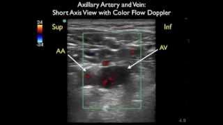 How To Axillary Vein Cannulation  Sonosite Ultrasoundmp4 [upl. by Gitel495]